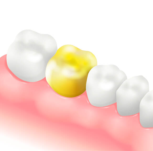 ゴールドインレー・ゴールドクラウンのイラスト