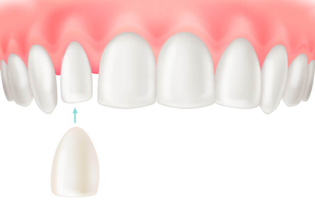 ラミネートベニアのイラスト