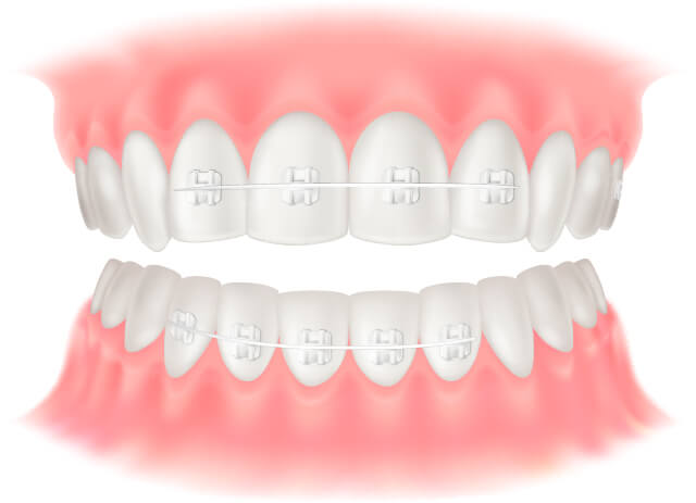 ワイヤー矯正のイラスト